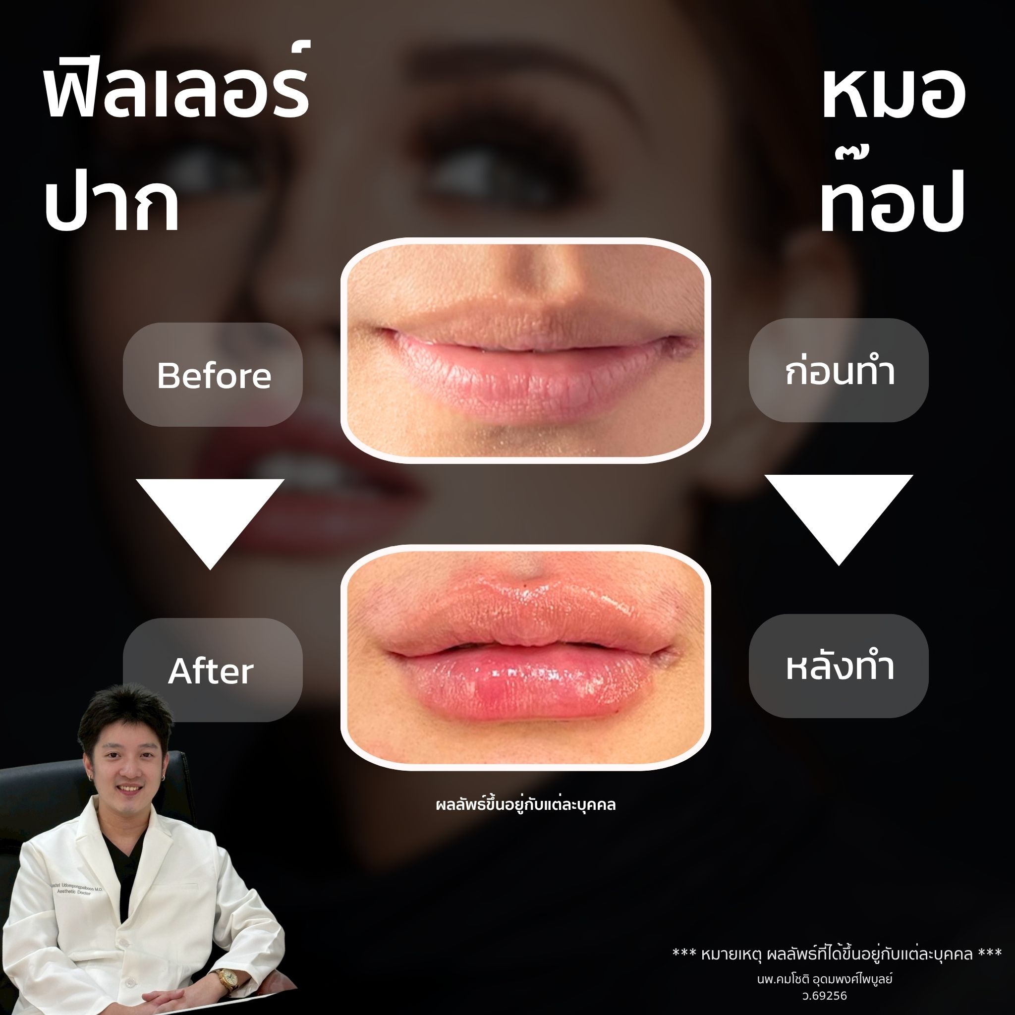 ภาพในแกลเลอรีฟิลเลอร์ปาก