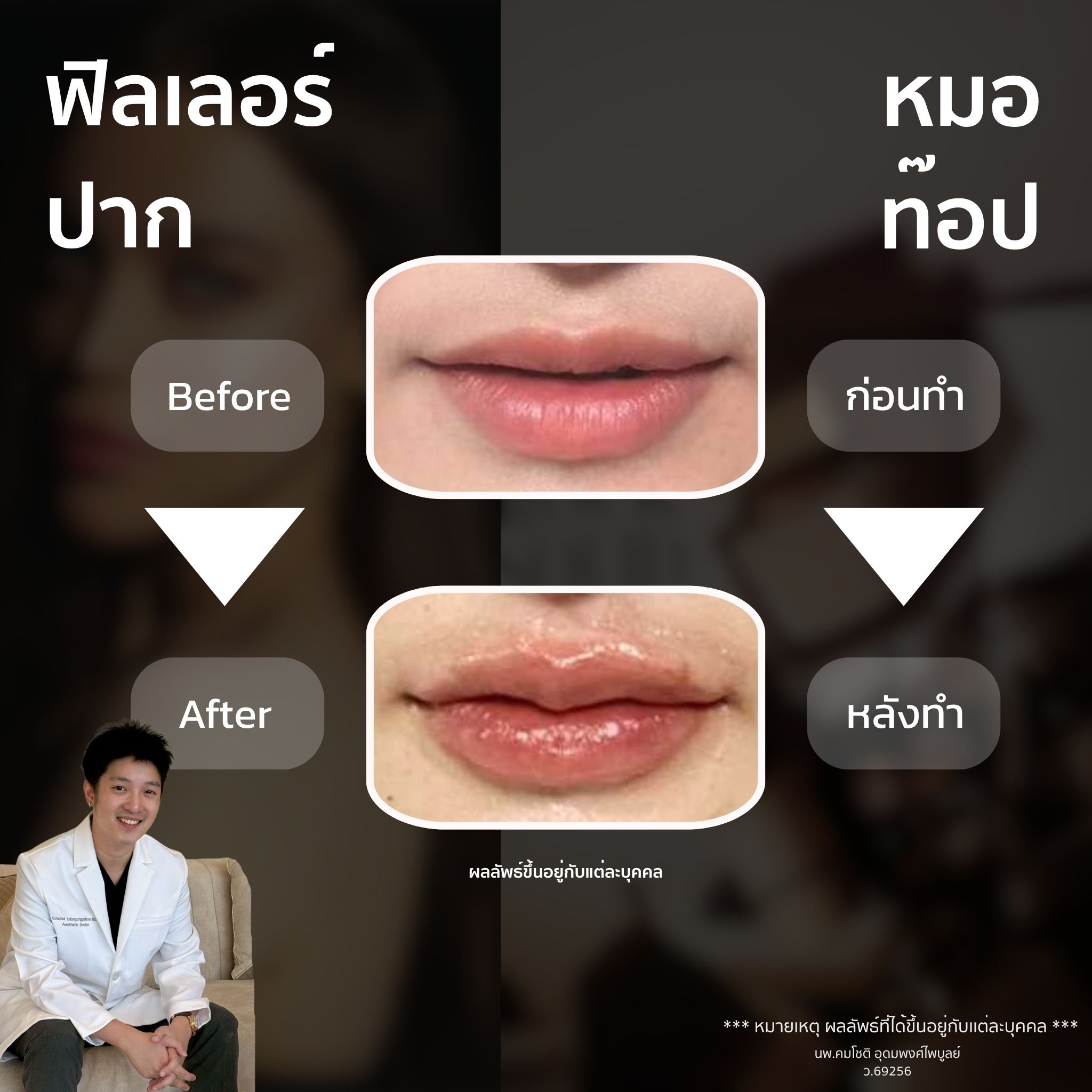 ภาพในแกลเลอรีฟิลเลอร์ปาก