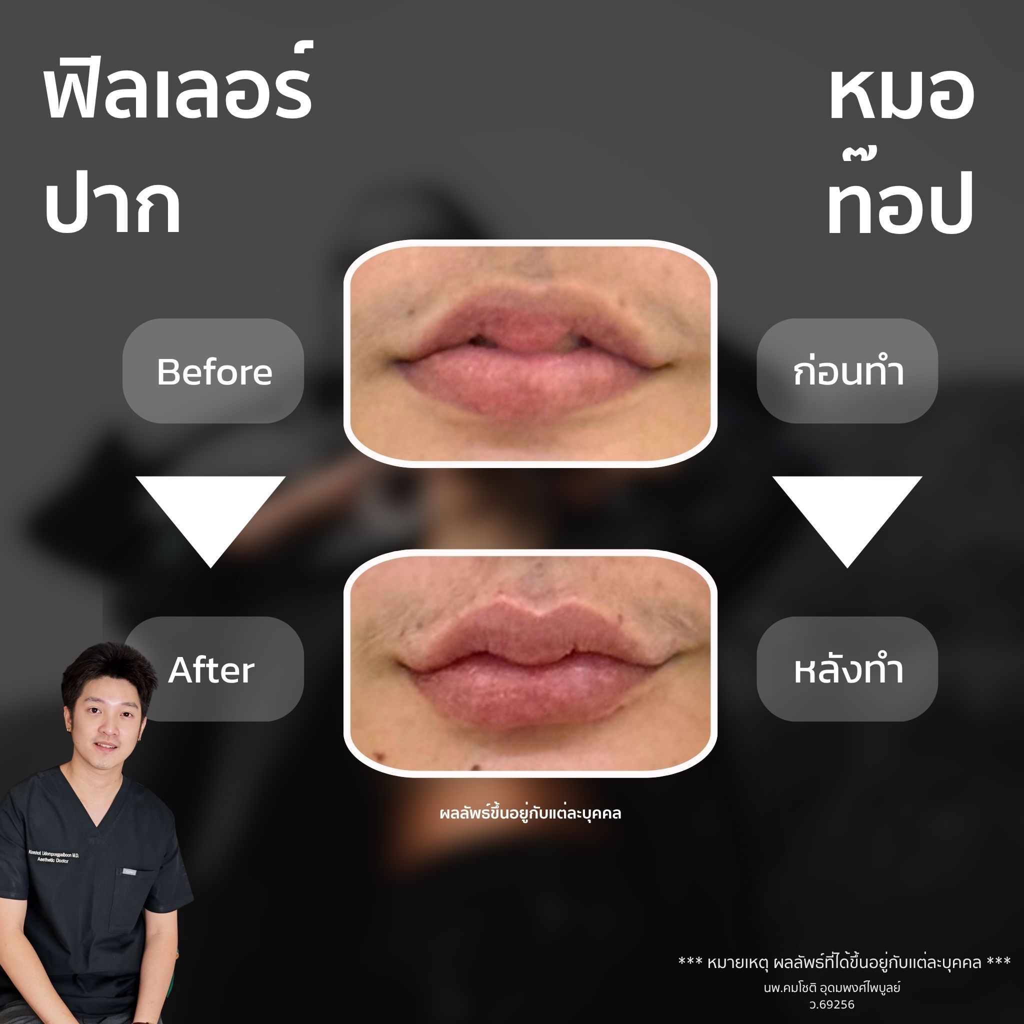 ภาพในแกลเลอรีฟิลเลอร์ปาก