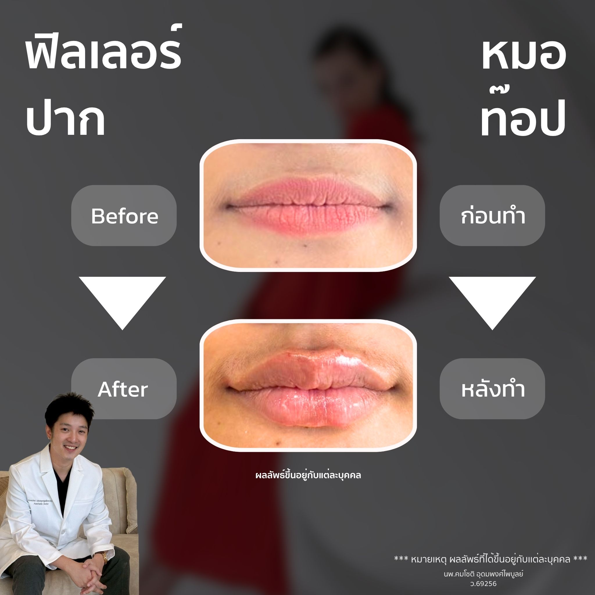 ภาพในแกลเลอรีฟิลเลอร์ปาก