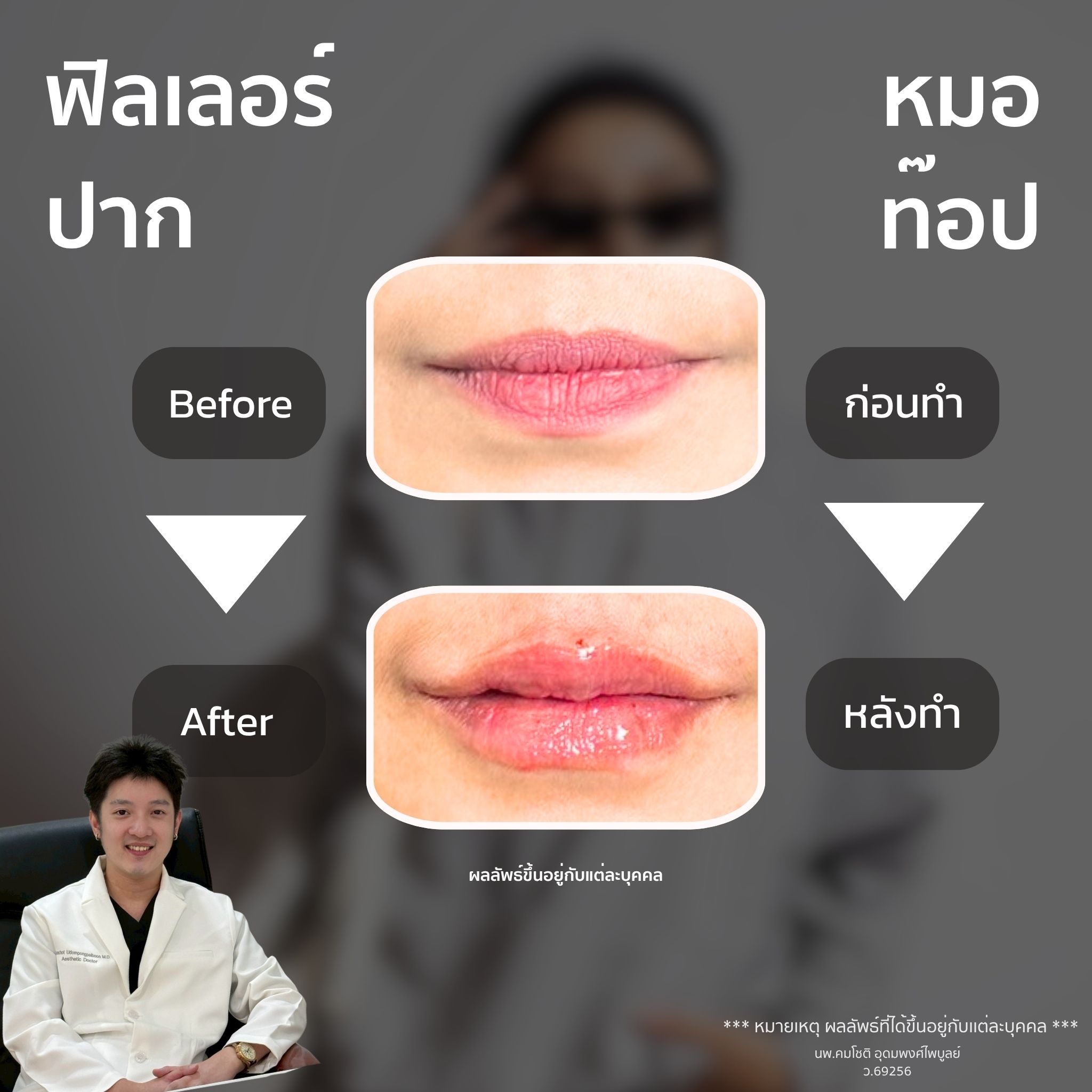 ภาพในแกลเลอรีฟิลเลอร์ปาก