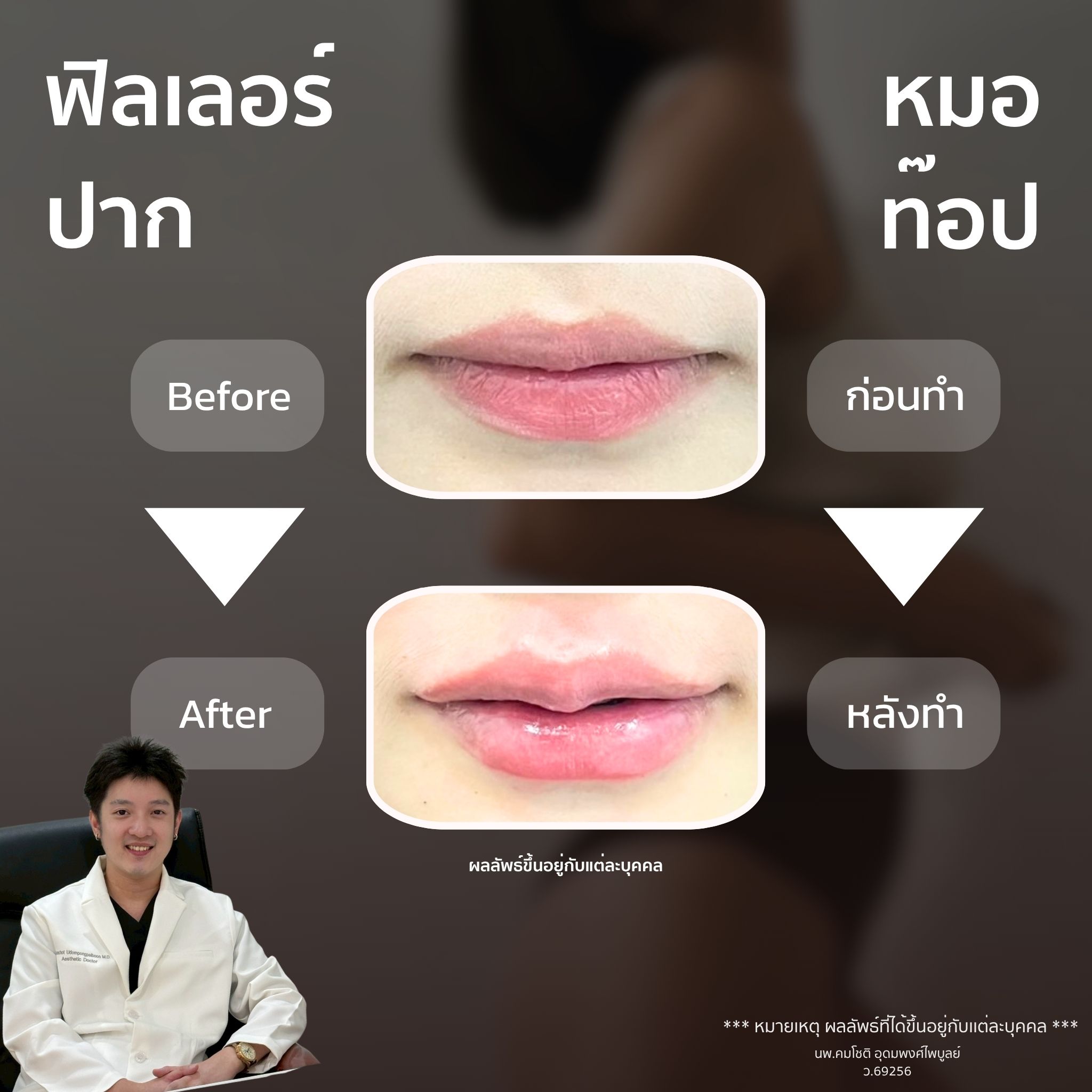 ภาพในแกลเลอรีฟิลเลอร์ปาก