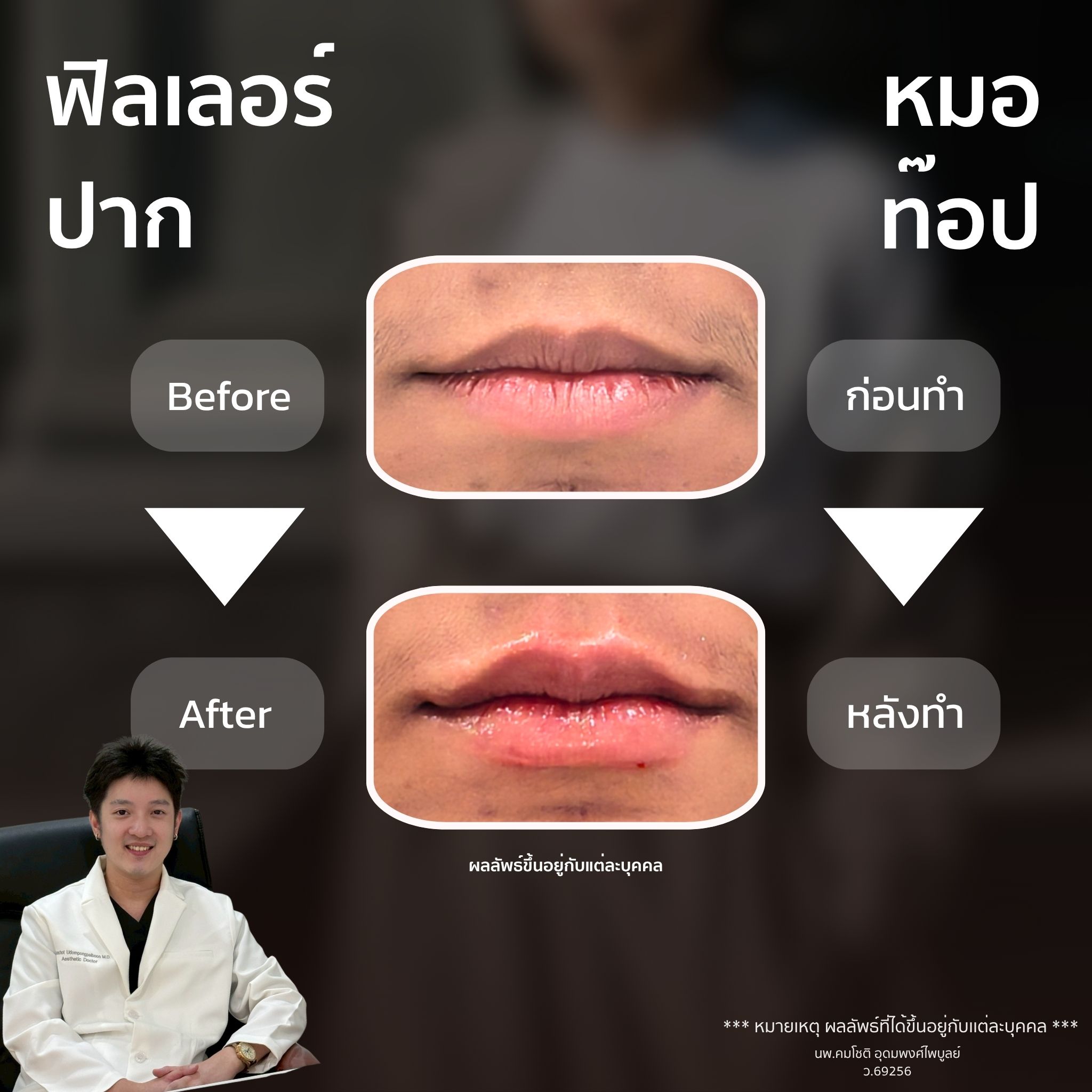 ภาพในแกลเลอรีฟิลเลอร์ปาก