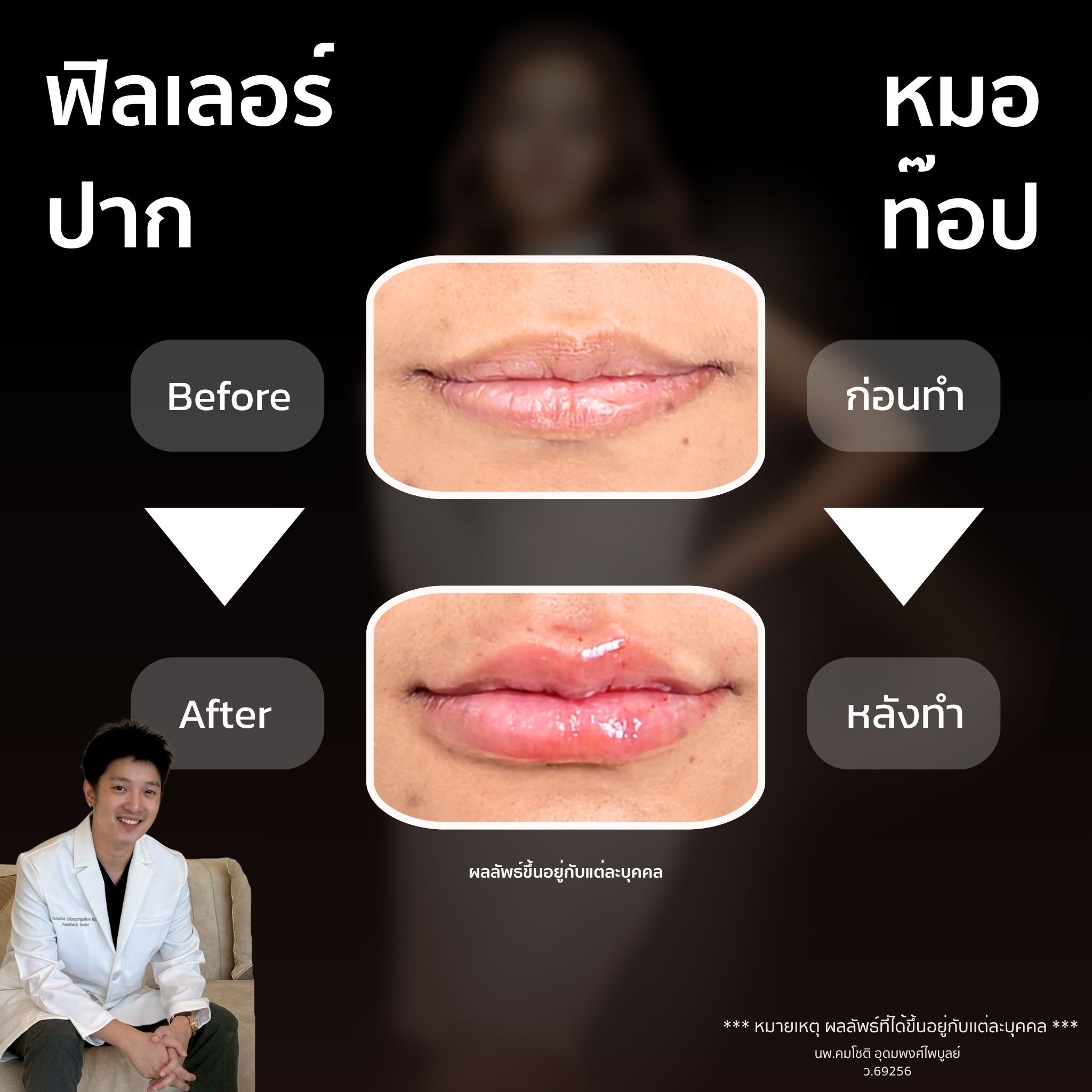 ภาพในแกลเลอรีฟิลเลอร์ปาก