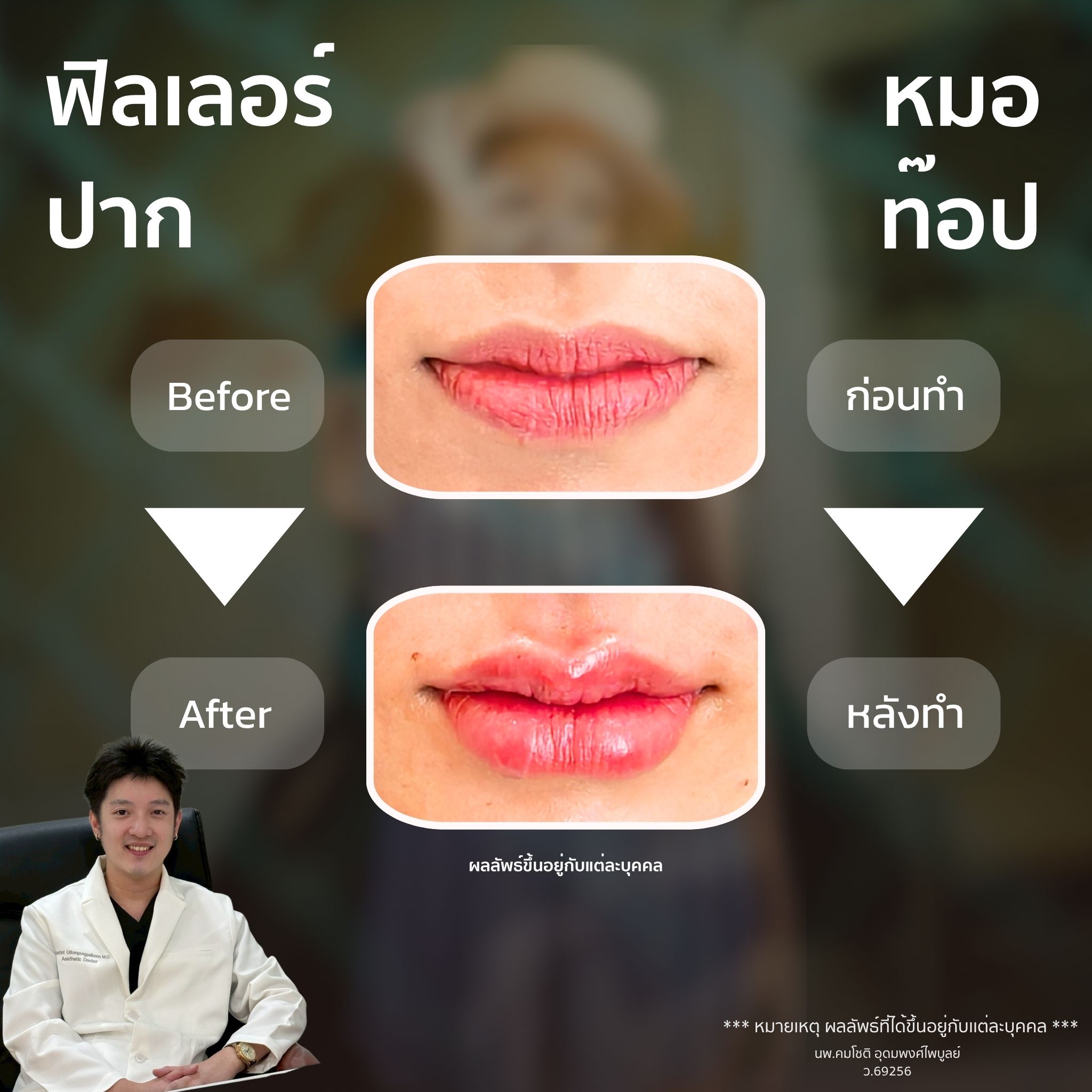 ภาพในแกลเลอรีฟิลเลอร์ปาก