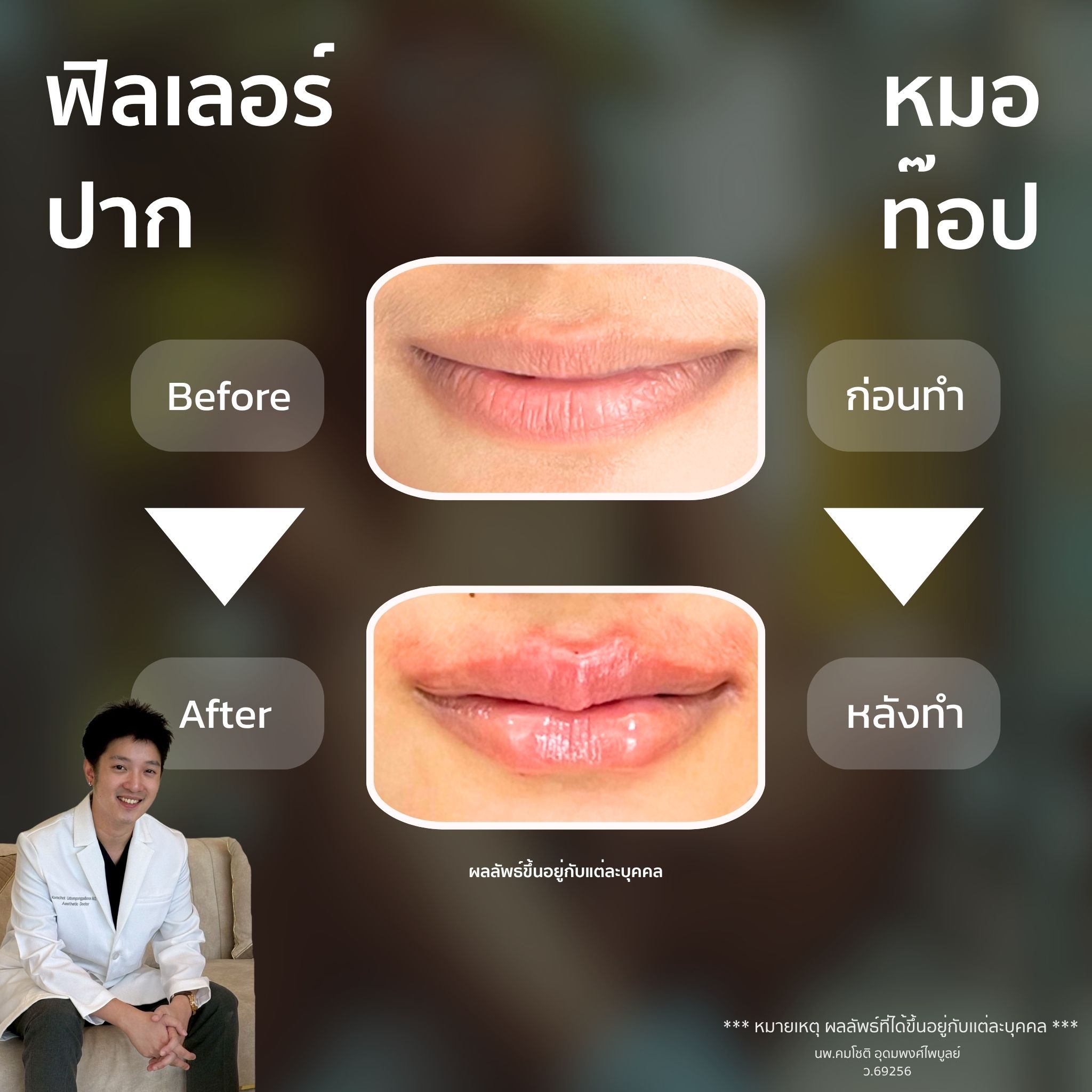 ภาพในแกลเลอรีฟิลเลอร์ปาก