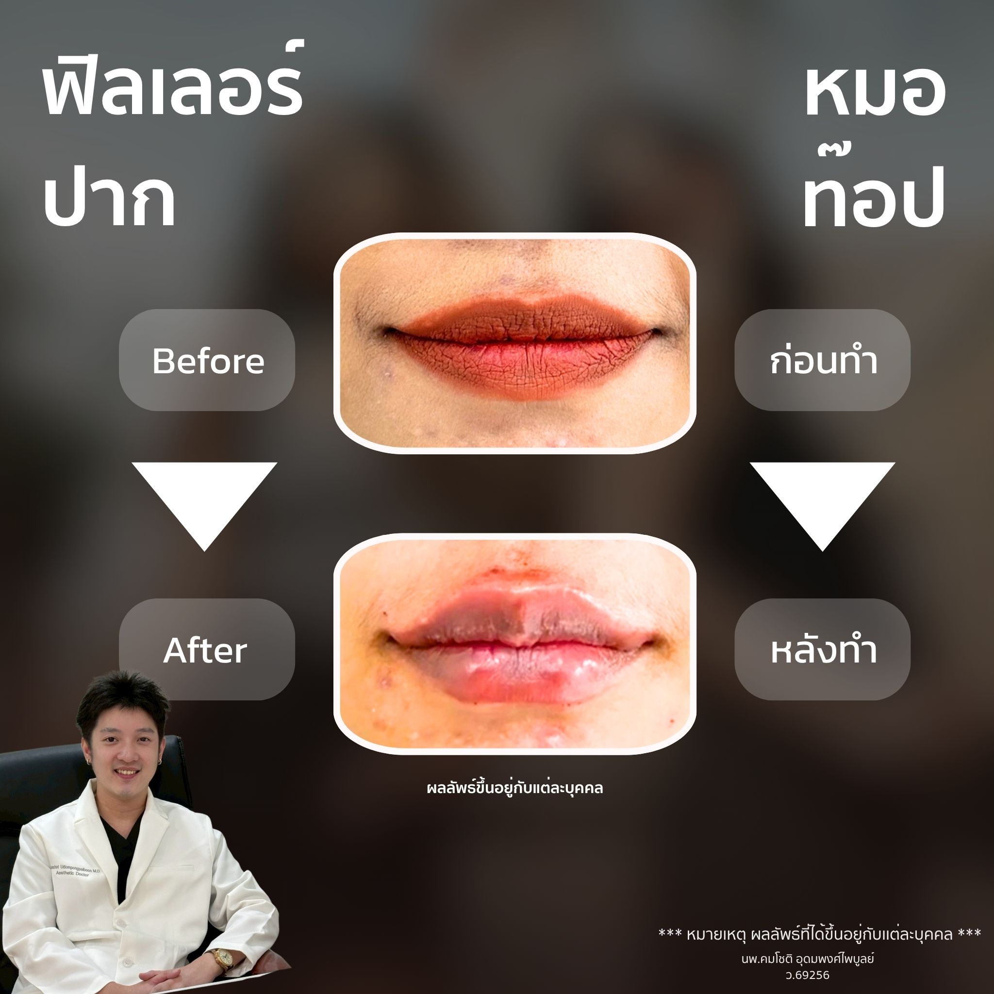 ภาพในแกลเลอรีฟิลเลอร์ปาก