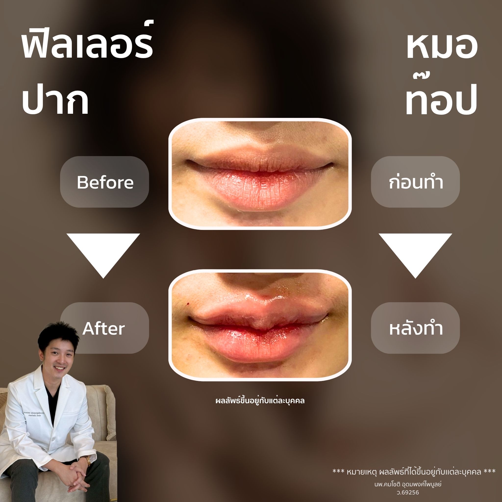 ภาพในแกลเลอรีฟิลเลอร์ปาก