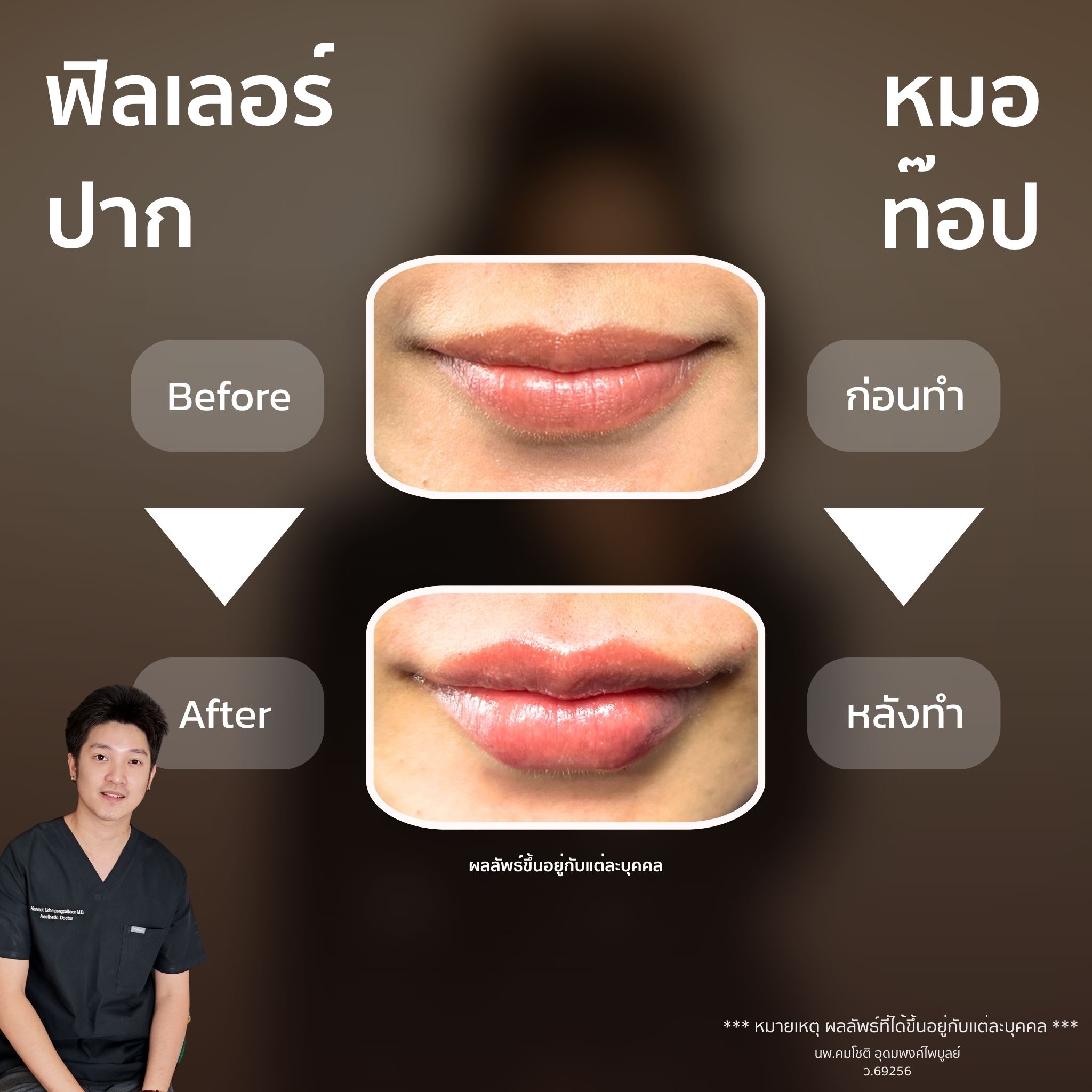 ภาพในแกลเลอรีฟิลเลอร์ปาก