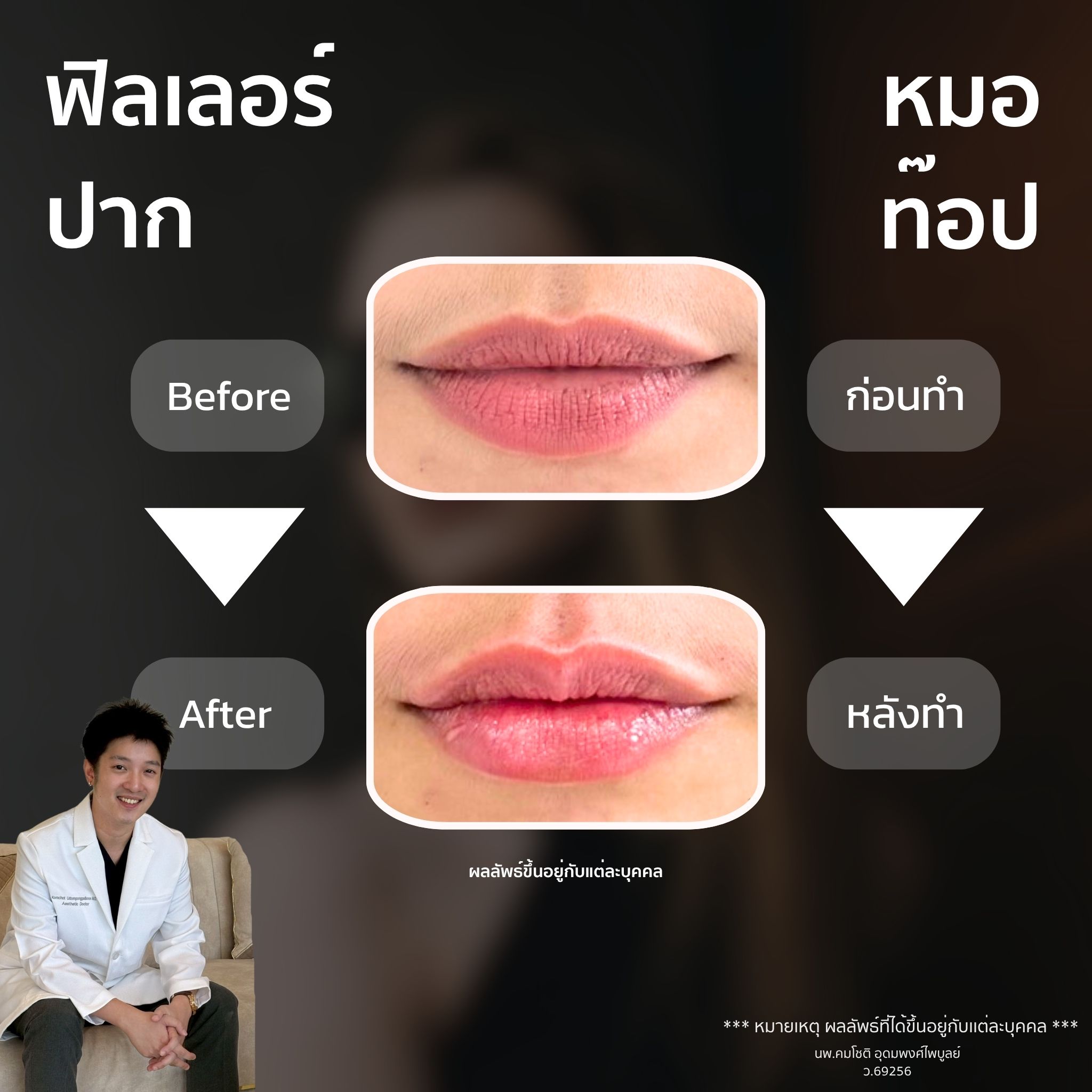 ภาพในแกลเลอรีฟิลเลอร์ปาก
