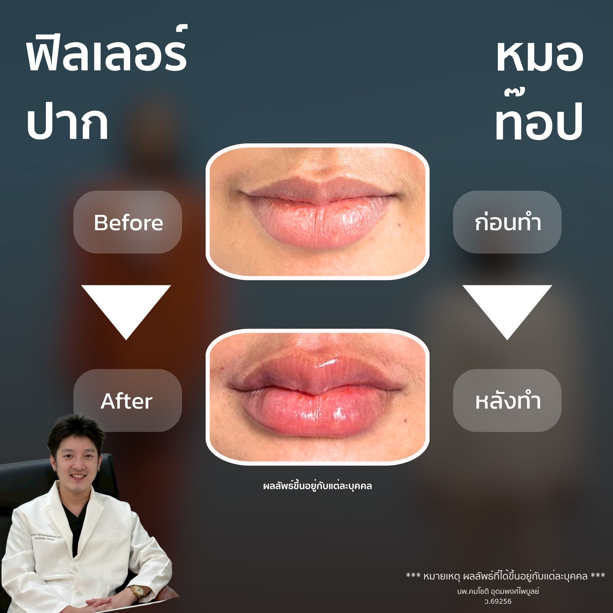 ภาพในแกลเลอรีฟิลเลอร์ปาก