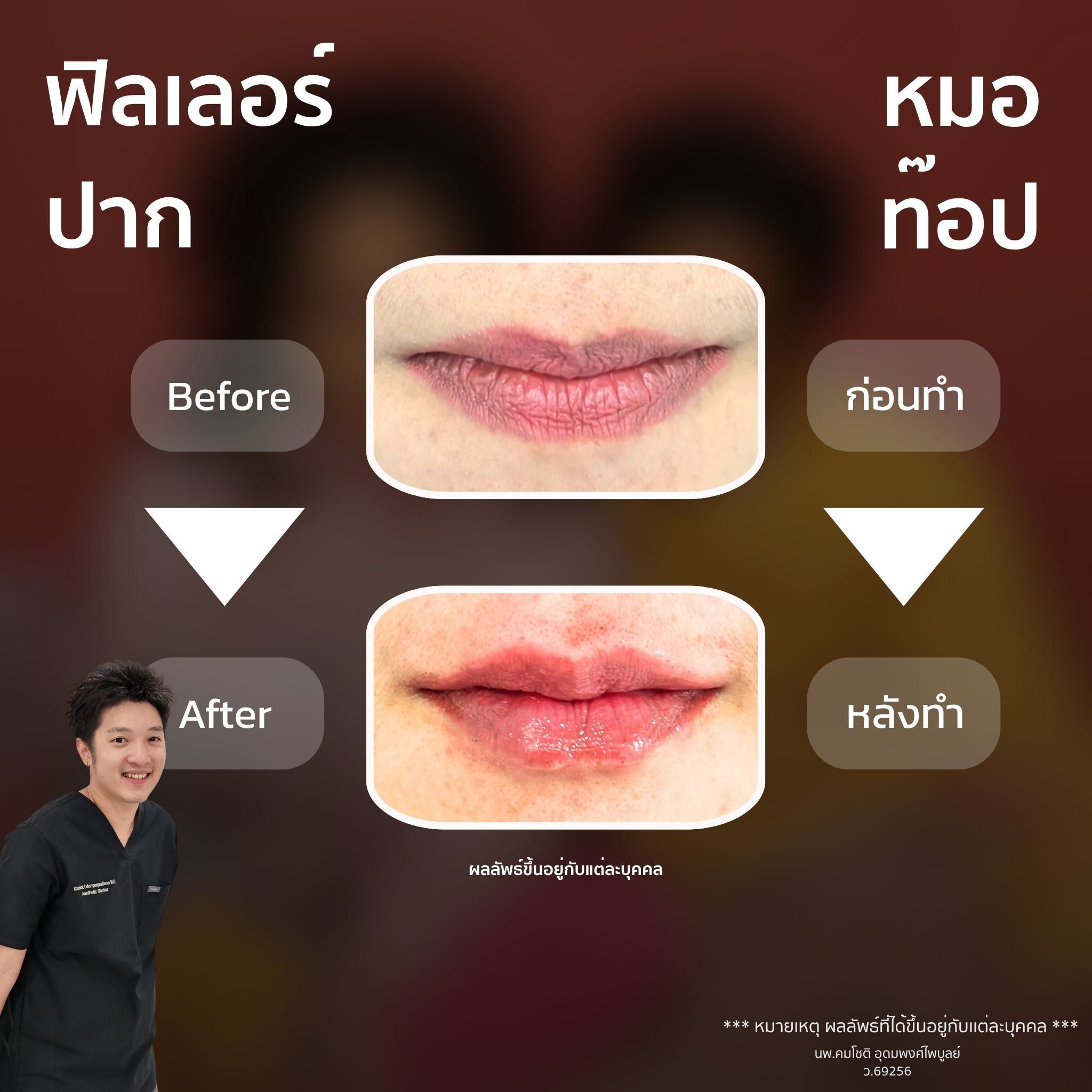 ภาพในแกลเลอรีฟิลเลอร์ปาก