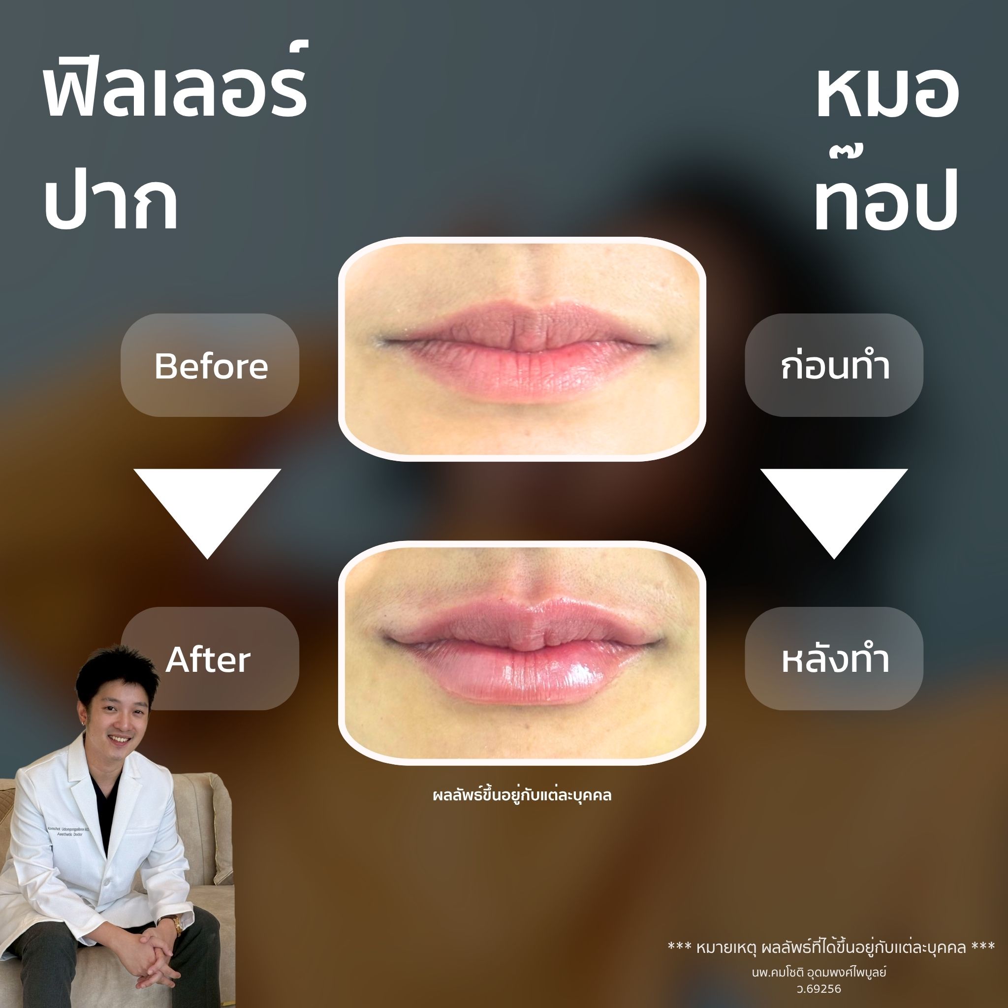 ภาพในแกลเลอรีฟิลเลอร์ปาก