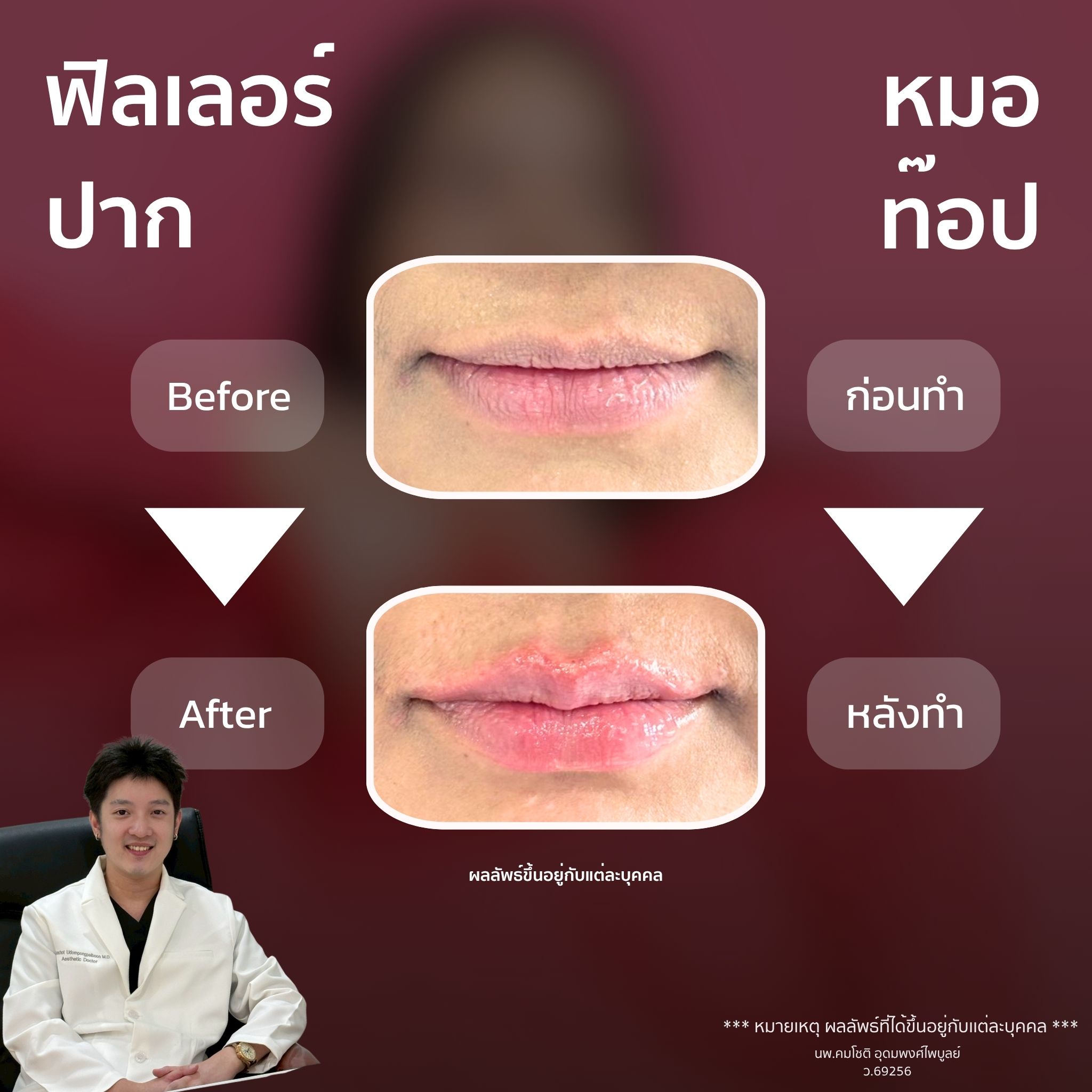 ภาพในแกลเลอรีฟิลเลอร์ปาก