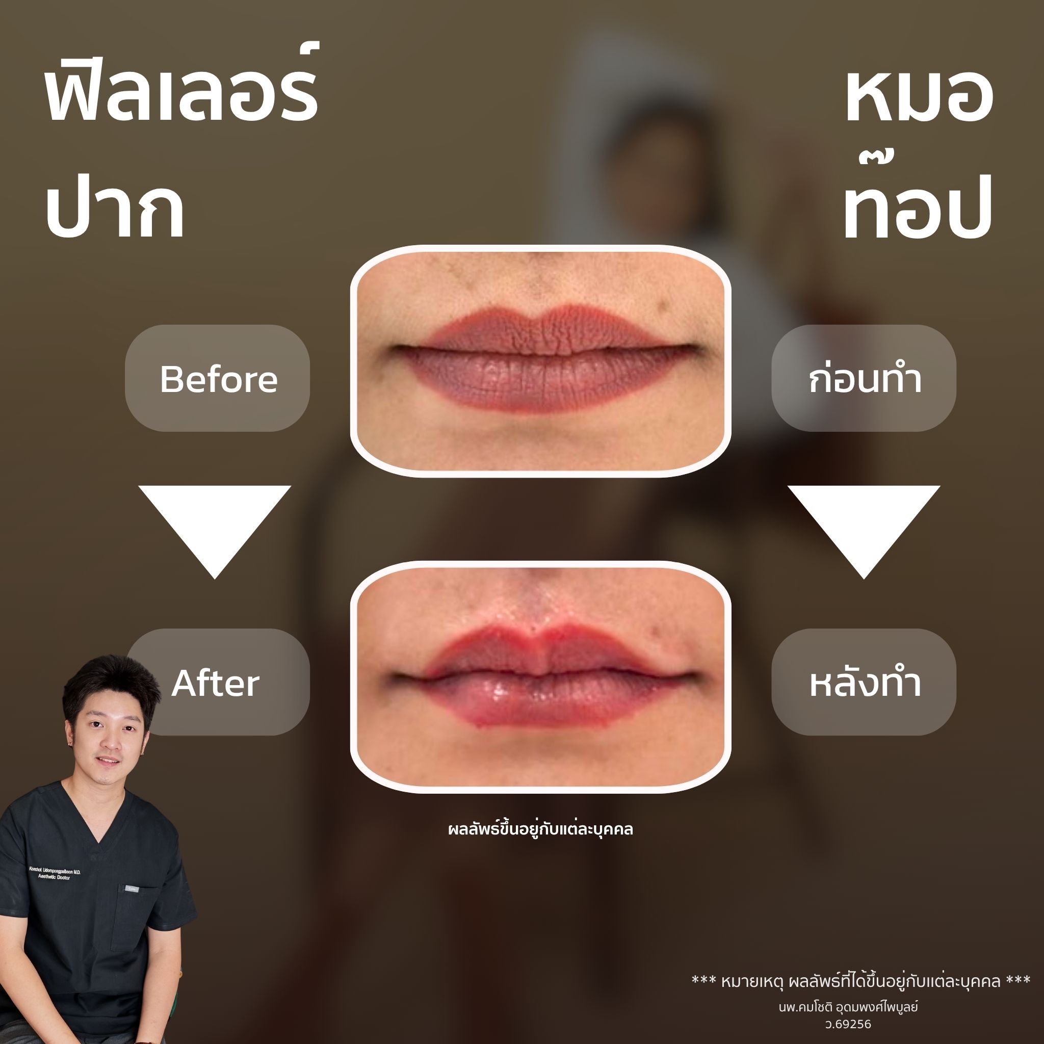 ภาพในแกลเลอรีฟิลเลอร์ปาก