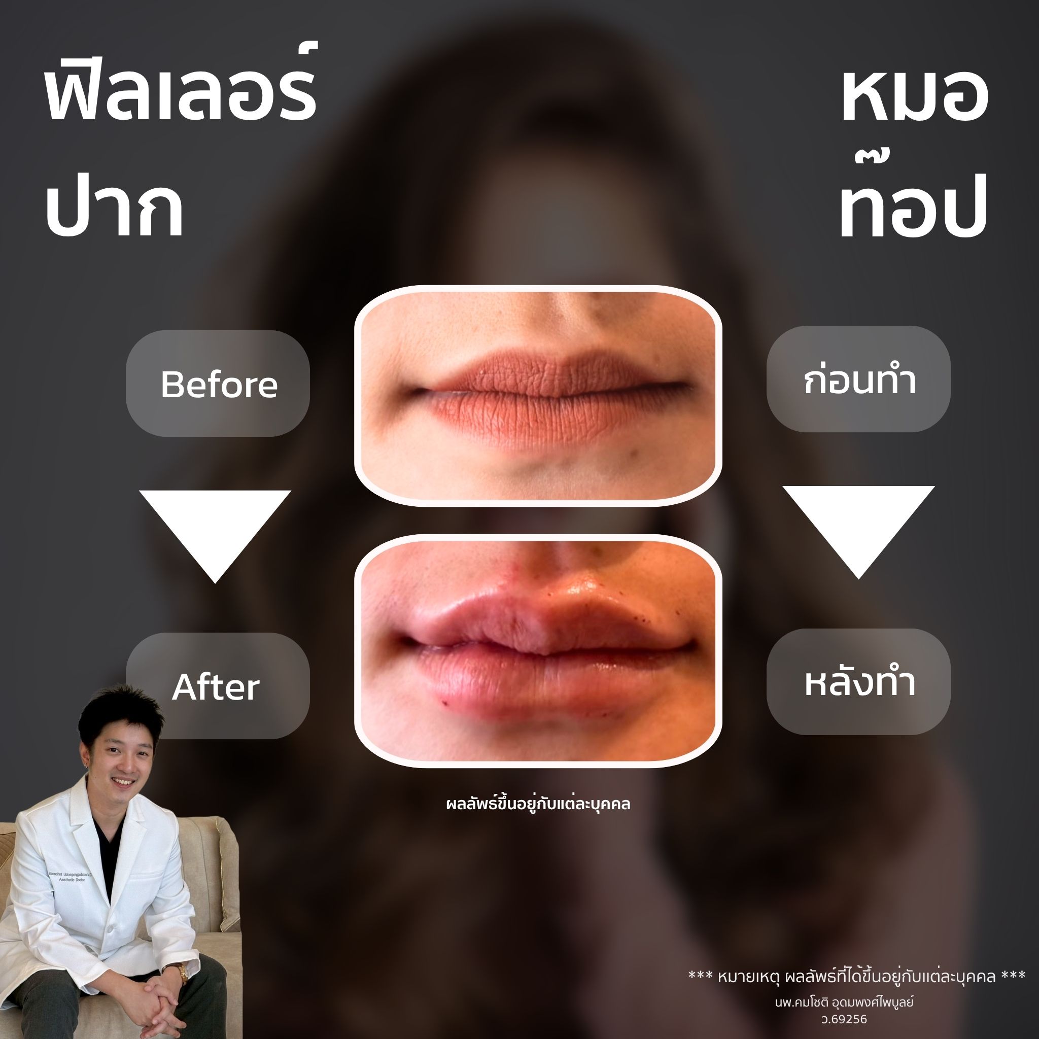 ภาพในแกลเลอรีฟิลเลอร์ปาก