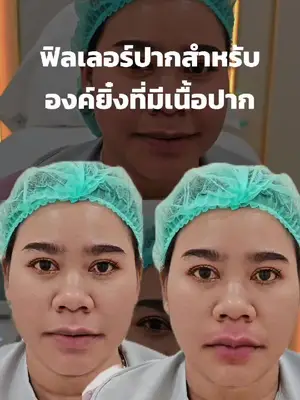 ภาพปกวิดีโอ: ฟิลเลอร์ปากสำหรับองค์ญิ๋งเนื้อปากเยอะ