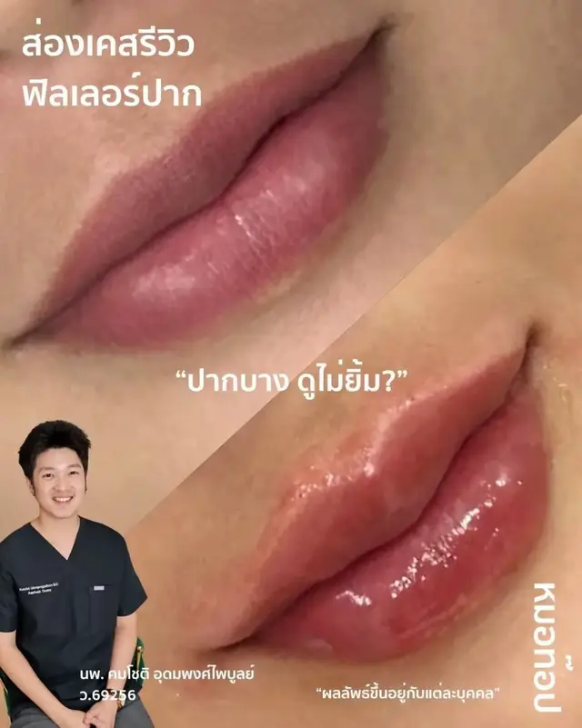 ภาพปกวิดีโอ: 🫦 ก่อนทำหัตถการ : 💚 โชคดีที่ปากเดิมมีทรงที่สวยอยู่เป็นพื้นฐาน 💚 มุมปากข้างขวาของคนไข้มีความยกน้อย กว่าข้างซ้ายเล็กน้อย 💚 ขอบปากยัง…