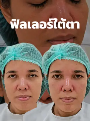 ภาพปกวิดีโอ: ฟิลเลอร์ใต้ตาอย่างเป็นระบบ