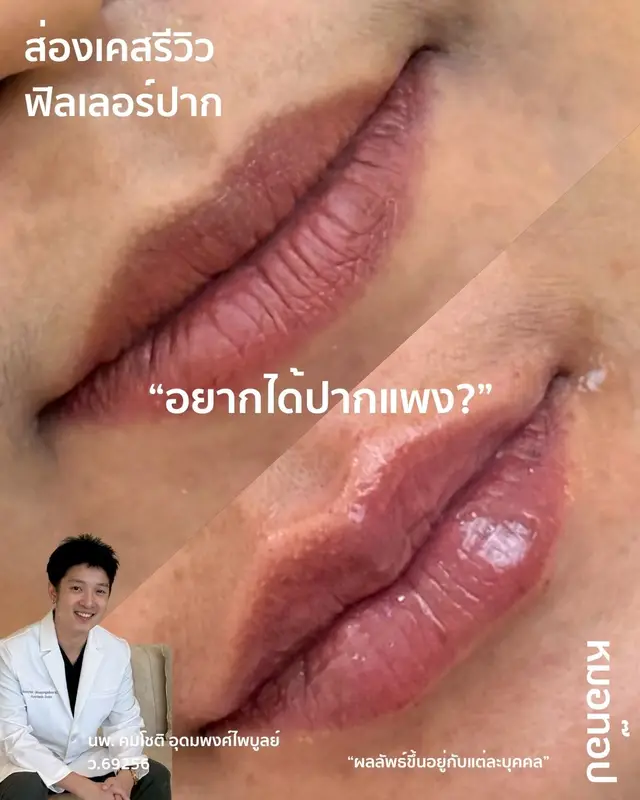ภาพปกวิดีโอ: 🫦 ก่อนทำหัตถการ : 💚 พื้นฐานปากมีทรงอยู่บ้างแล้ว 💚 มุมปากดูไม่ค่อยยิ้ม 💚 ปากล่างตกร่อง 💚 ปากดูบาง 💚 ไม่มีร่อง 11🫦 หลังทำหัตถการ 1 c…