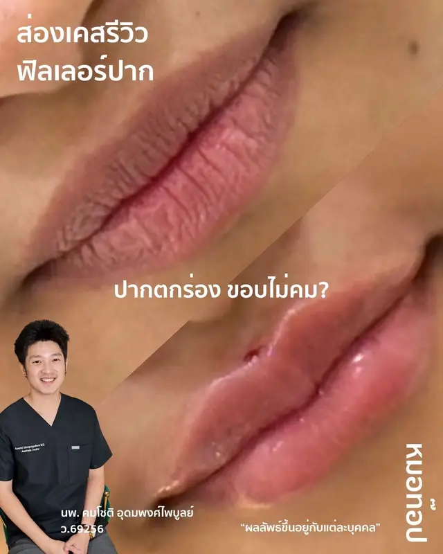 ภาพปกวิดีโอ: 🫦 ก่อนทำหัตถการ : 💚 พื้นฐานปากไม่ค่อยมีทรง 💚 มุมปากราบเป็นแนวตรง ไม่ยิ้ม 💚 ขอบปากยังเบลอไม่ชัดเจน 💚 ปากตกร่องค่อนข้างมาก เนื้อ…