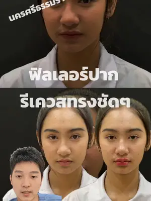 ภาพปกวิดีโอ: ฟิลเลอร์ปากทรงชัดๆ