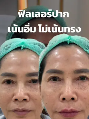 ภาพปกวิดีโอ: ฟิลเลอร์ปากเน้นอวบอิ่ม