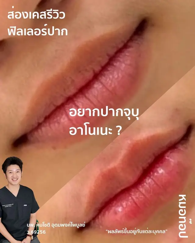 ภาพปกวิดีโอ: 🫦 ก่อนทำหัตถการ : 💚 พื้นฐานปากบนและล่างไม่ค่อยมีทรง 💚 มุมปากไม่ยิ้ม 💚 ปากมีความตกร่อง 💚 ขอบปากไม่คมชัด 💚 ไม่มีร่อง 11
