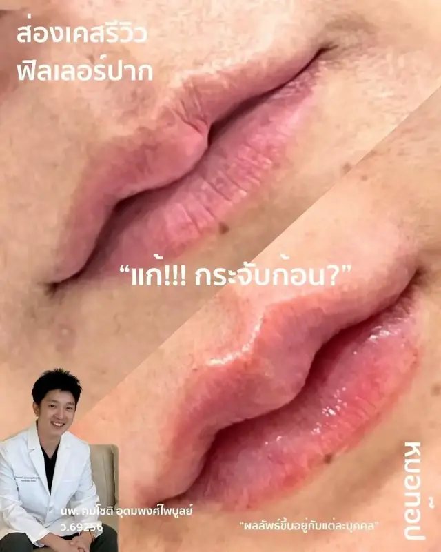 ภาพปกวิดีโอ: 🫦 ก่อนทำหัตถการ : 💚 พื้นฐานปากมีทรง เพราะเคยเติมมาแล้ว 💚 มุมปากดูยิ้มไม่เท่ากัน 💚 ลูกเชอรี่เริ่มหาย 💚 ปากบางลงแล้ว 💚 กระจับดูเป็น…