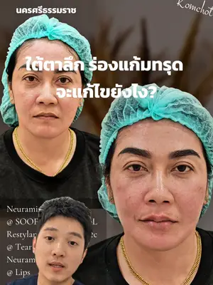 ภาพปกวิดีโอ: ใต้ตาร่องแก้ม แก้ไขด้วยฟิลเลอร์แบบไหน