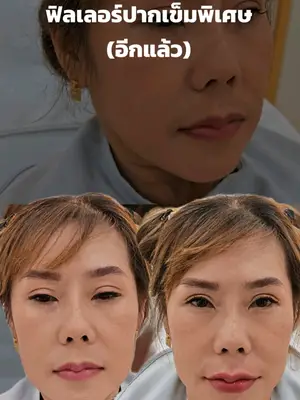 ภาพปกวิดีโอ: ฟิลเลอร์ปากเส้นคม (อีกแล้ว